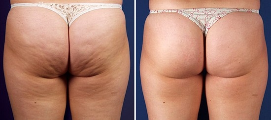 Глина в борьбе против целлюлита: отзывы