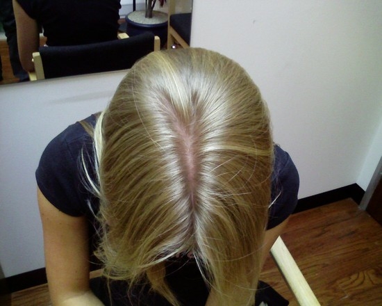 Причины диффузной алопеции у женщин